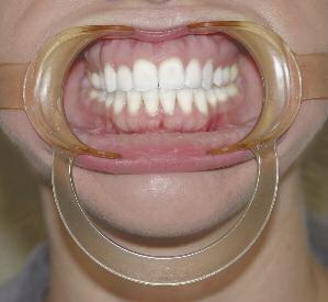 Depărtător extraoral Ortho Technology – imagine ilustrativă model Adult, catalog 2014