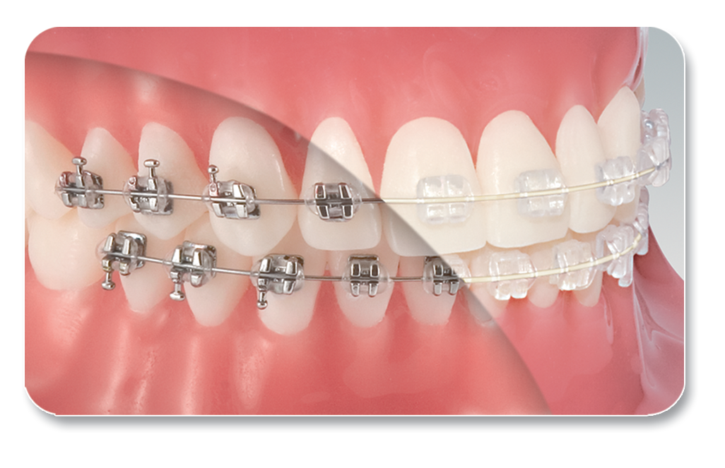 Imagine comparativă Tooth Tone: arc cu acoperire sus și arc neacoperit jos; ilustrație generică
